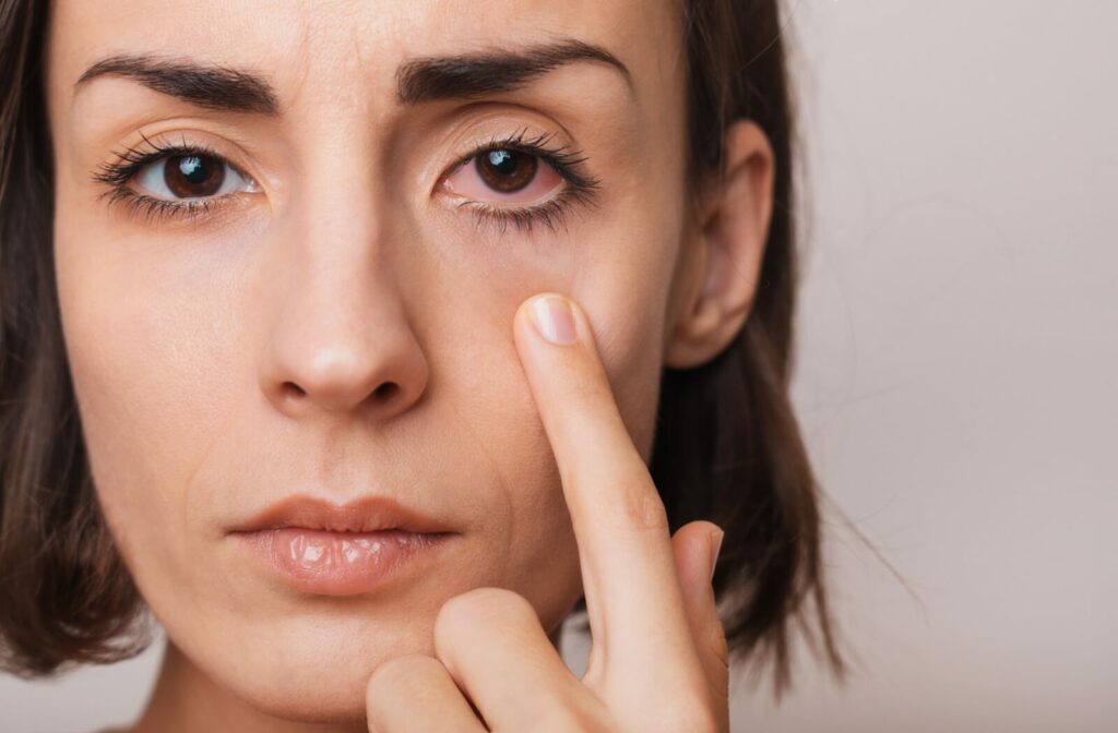 A person pointing to their pink, irritated eye.