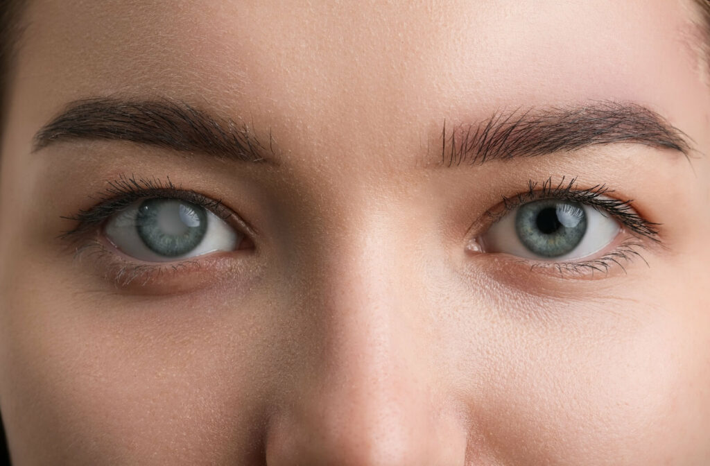 A close-up of a person's eyes where one eye has a noticeably cloudy, white pupil, illustrating the advanced visual symptoms of glaucoma or cataracts.
